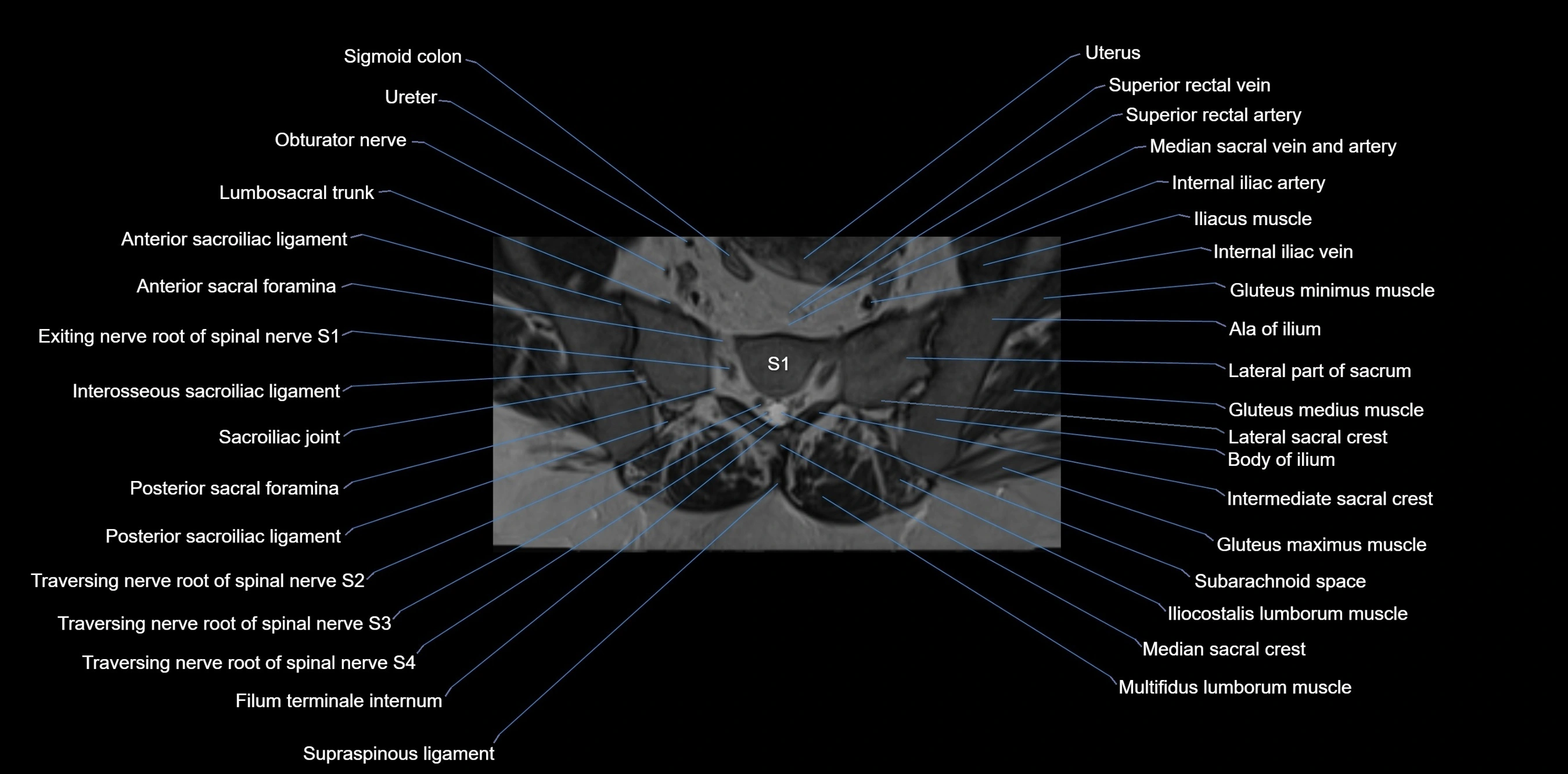 MRI sacrum, coccyx and sacroiliac joint axial cross sectional anatomy 3T  radiology  image-img-00001-00018.webp